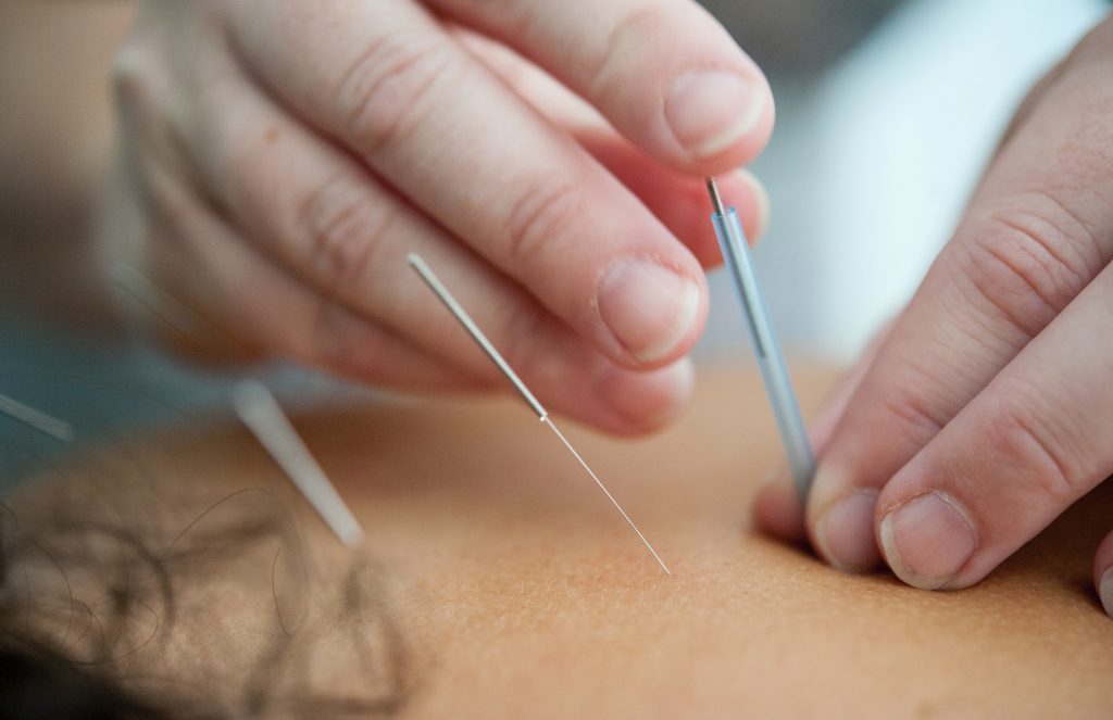 Trusted acupuncture specialist
